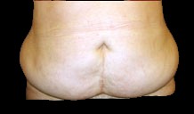 Tummy Tuck Before & After Patient #728