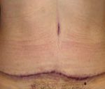 Tummy Tuck Before & After Patient #728