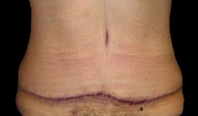 Tummy Tuck Before & After Patient #728