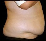 Tummy Tuck Before & After Patient #728