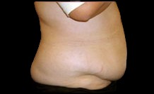 Tummy Tuck Before & After Patient #728