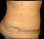Tummy Tuck Before & After Patient #728