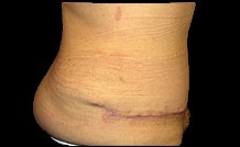 Tummy Tuck Before & After Patient #728
