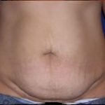 Tummy Tuck Before & After Patient #733