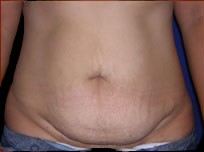 Tummy Tuck Before & After Patient #733