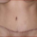 Tummy Tuck Before & After Patient #733