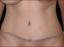 Tummy Tuck Before & After Patient #733