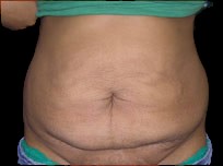 Tummy Tuck Before & After Patient #734