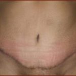Tummy Tuck Before & After Patient #734