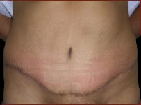 Tummy Tuck Before & After Patient #734