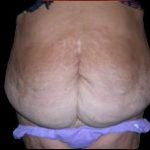 Tummy Tuck Before & After Patient #735