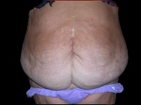 Tummy Tuck Before & After Patient #735