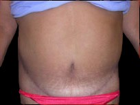 Tummy Tuck Before & After Patient #735