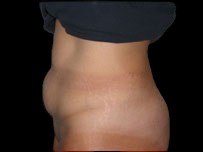 Tummy Tuck Before & After Patient #736