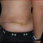 Tummy Tuck Before & After Patient #736