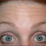 BOTOX® Before & After Patient #1169