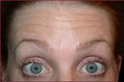 BOTOX® Before & After Patient #1169