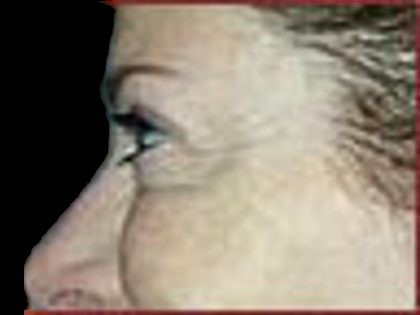 BOTOX® Before & After Patient #1171