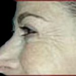 BOTOX® Before & After Patient #1171