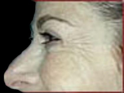 BOTOX® Before & After Patient #1171