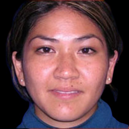 Chemical Peel Before & After Patient #1173