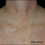 Skin Rejuvenation Before & After Patient #1229
