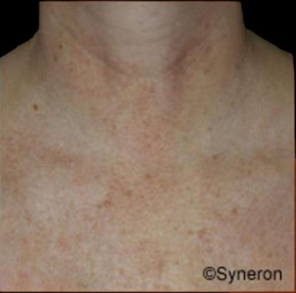Skin Rejuvenation Before & After Patient #1229
