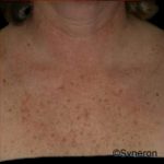 Skin Rejuvenation Before & After Patient #1229