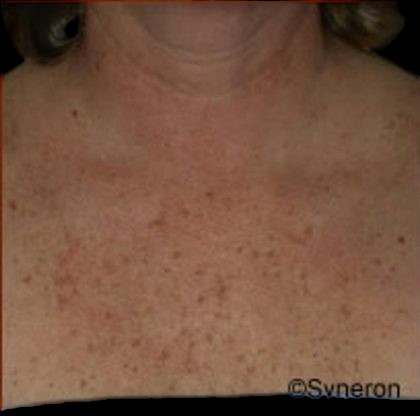 Skin Rejuvenation Before & After Patient #1229