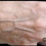 Skin Rejuvenation Before & After Patient #1231