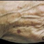 Skin Rejuvenation Before & After Patient #1231