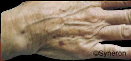 Skin Rejuvenation Before & After Patient #1231