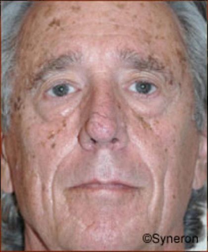 Skin Rejuvenation Before & After Patient #1232