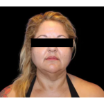 Neck Liposuction Before & After Patient #2826