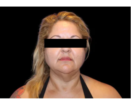 Neck Liposuction Before & After Patient #2826