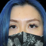Blepharoplasty Before & After Patient #2478