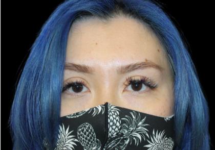 Blepharoplasty Before & After Patient #2478