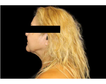 Neck Liposuction Before & After Patient #2826