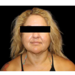 Neck Liposuction Before & After Patient #2826