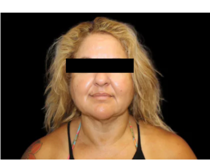 Neck Liposuction Before & After Patient #2826