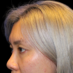 Blepharoplasty Before & After Patient #2478