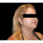 Neck Liposuction Before & After Patient #2826