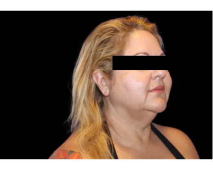 Neck Liposuction Before & After Patient #2826