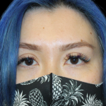 Blepharoplasty Before & After Patient #2478
