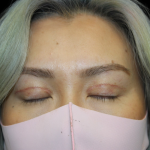 Blepharoplasty Before & After Patient #2478
