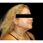 Neck Liposuction Before & After Patient #2826