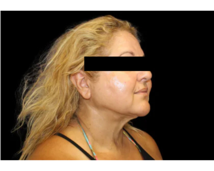 Neck Liposuction Before & After Patient #2826