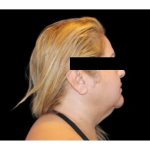 Neck Liposuction Before & After Patient #2826