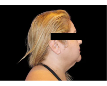 Neck Liposuction Before & After Patient #2826