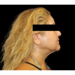 Neck Liposuction Before & After Patient #2826